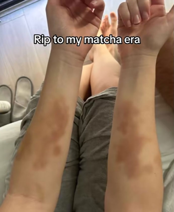 Woman showing discolored skin patches on forearms warning about matcha after hospital visit from trendy drink effects.
