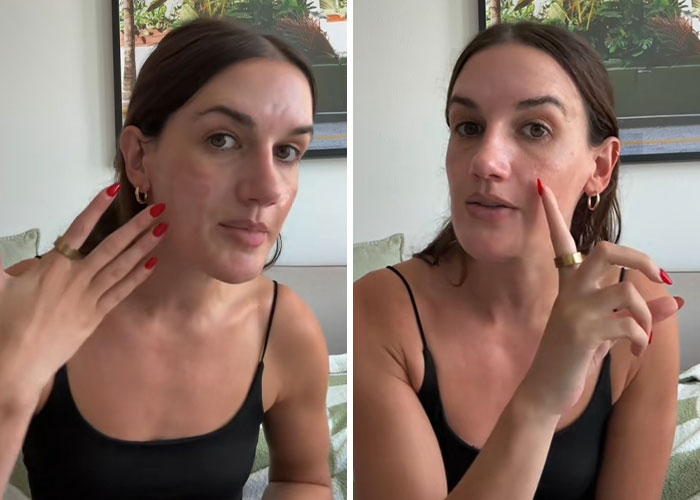 Woman showing facial scars and damage, discussing $90,000 repairs after celebrity facialist caused permanent disfigurement.