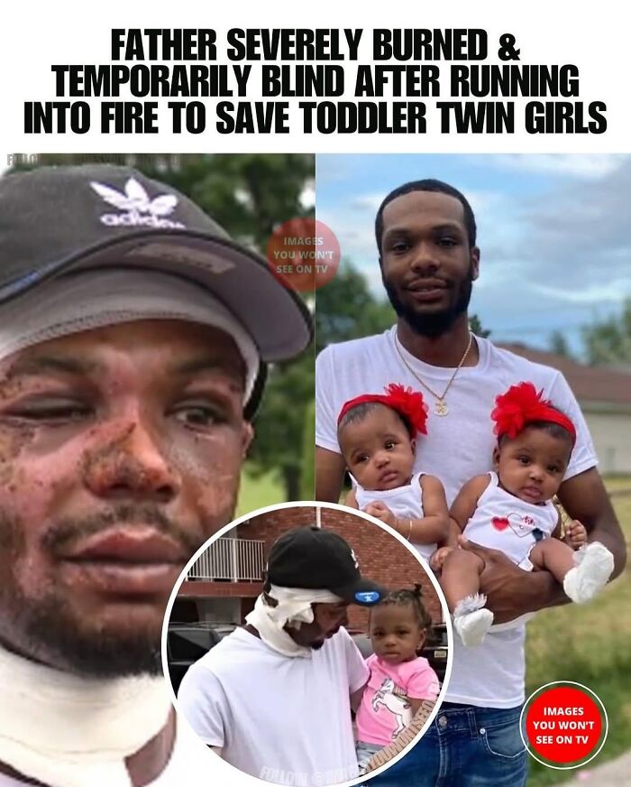 Father severely burned saving toddler twin girls, featured in wholesome posts to distract from the current horrors of the world.