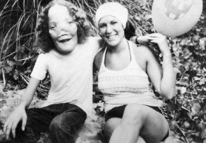 Two women sitting outdoors, one with a rare facial condition, illustrating surprising things about their bodies.