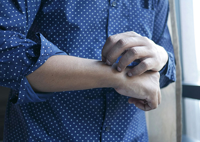 &ldquo;They Weren&rsquo;t Real Burgers&rdquo;: Woman Goes Into Anaphylactic Shock After BIL Lies About The Food