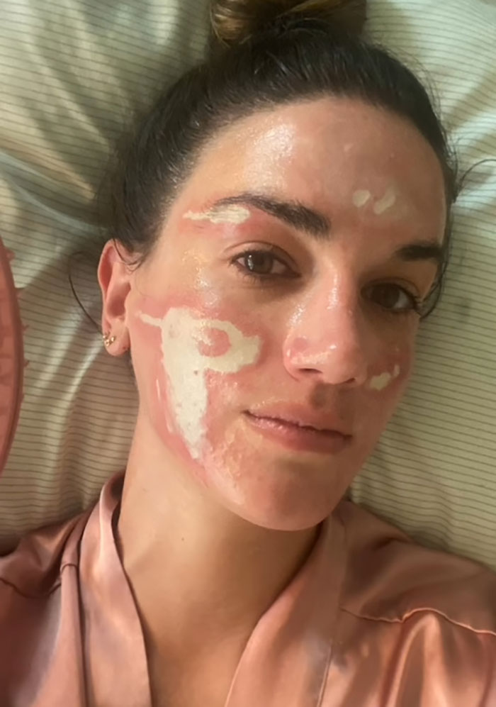 Woman with facial burns and discoloration, showing damage after celebrity facialist treatment and costly $90,000 repairs.