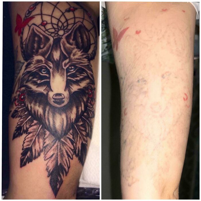 Before and after photos showing fading and removal of a detailed wolf and dreamcatcher tattoo on forearm.