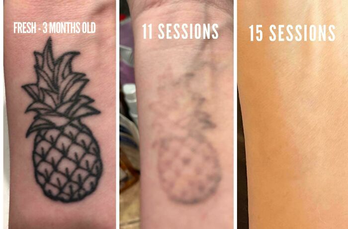 Tattoo removal progress showing fading pineapple tattoo after multiple sessions, illustrating tattoo mistakes fix over time.