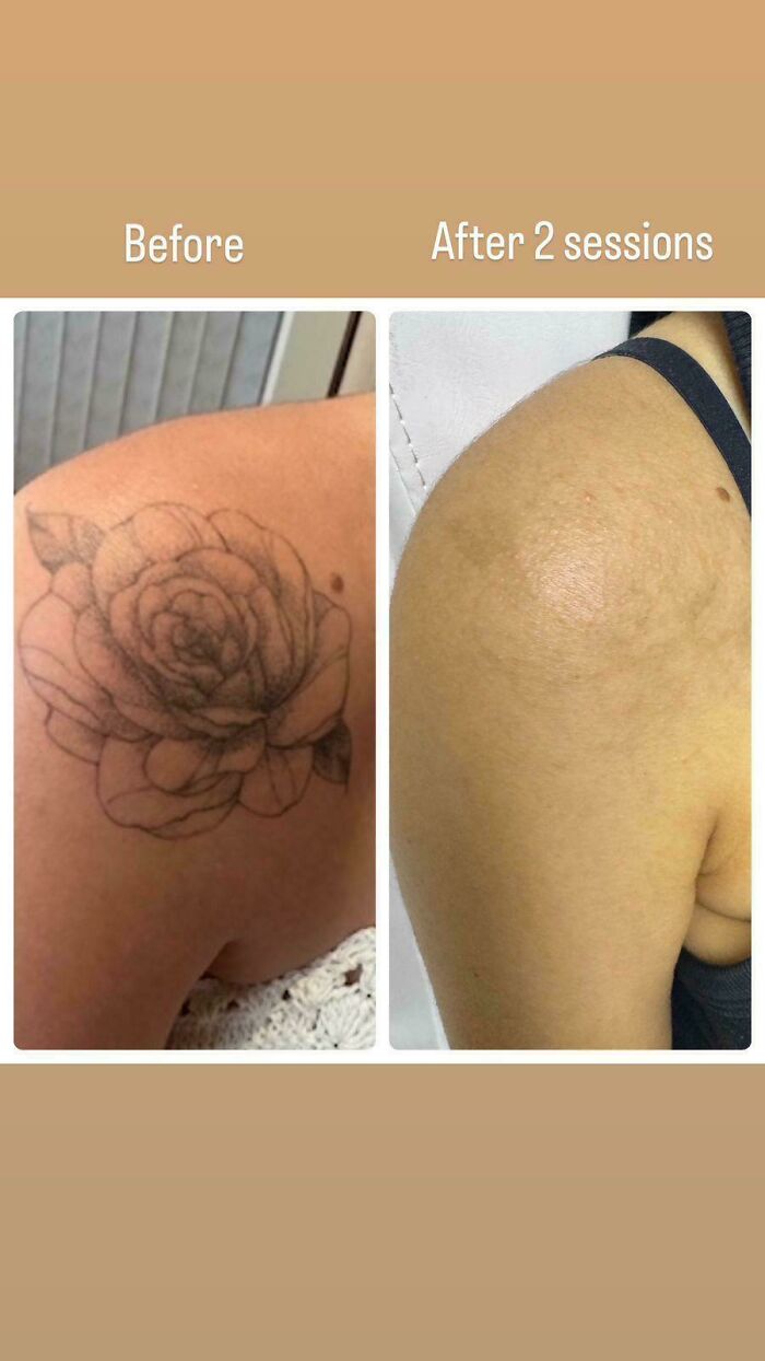 Before and after tattoo removal photos showing faded floral tattoo after two laser sessions on upper arm.