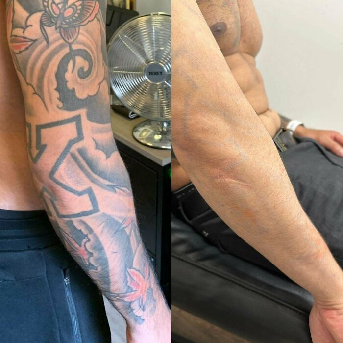 Before and after photos showing tattoo mistake removal on a man's forearm, highlighting modern tattoo correction results.