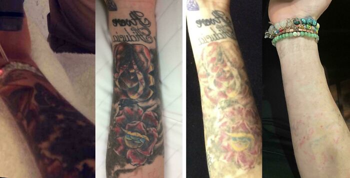 Arm showing tattoo removal progress in before and after photos demonstrating tattoo mistakes correction.