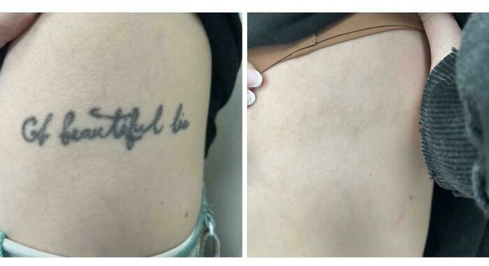 Faded tattoo error on skin showing removal results, demonstrating tattoo mistakes are not permanent anymore.