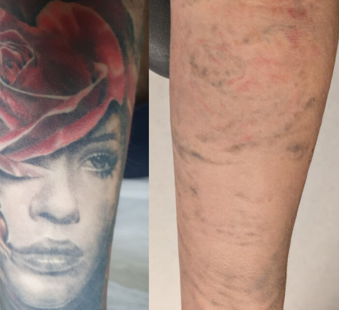 Before and after photos showing tattoo mistakes fade with skin healing and removal treatments on a forearm.