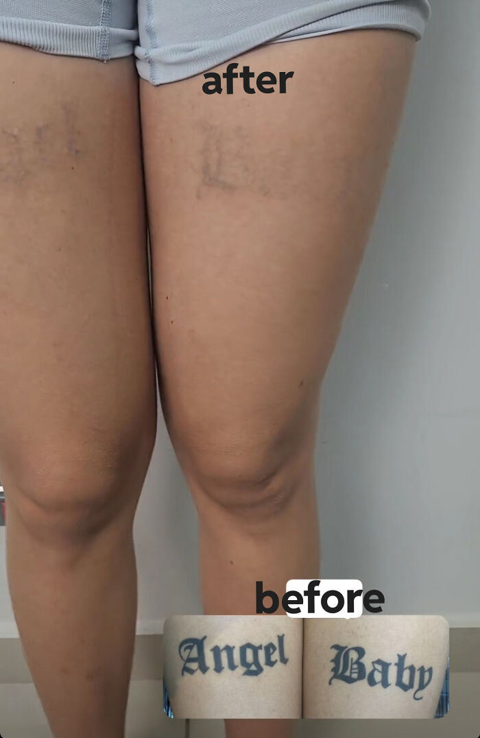 Legs showing tattoo removal before and after photos, highlighting how tattoo mistakes aren’t permanent anymore.