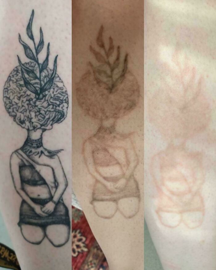 Faded tattoo cover-up progression on skin showing tattoo mistakes aren't permanent with visible before and after stages.