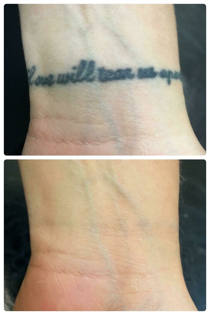 Faded tattoo removal on wrist shown in before and after photos demonstrating tattoo mistakes correction.