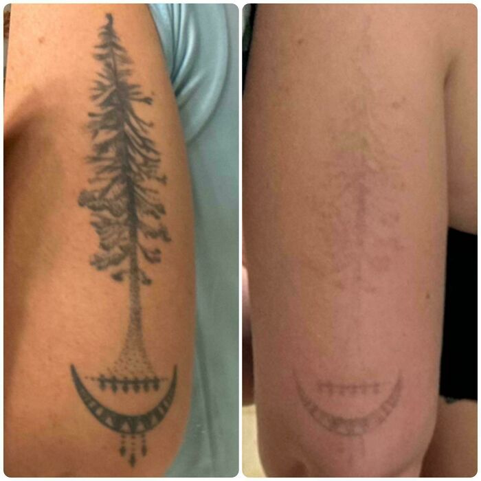 Before and after photos of tattoo removal showing fading of a black tree and crescent moon tattoo on the upper arm.