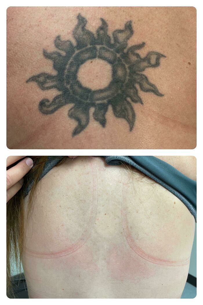 Faded sun tattoo on skin in before photo and clear skin without tattoo in after removal treatment.