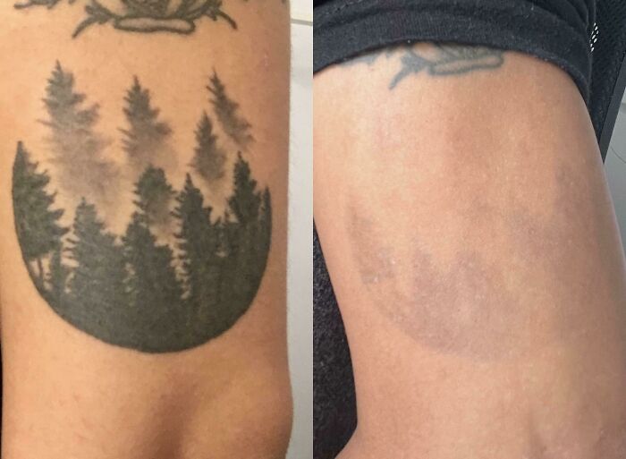 Faded forest tattoo before and after removal showing how tattoo mistakes aren’t permanent anymore on skin.