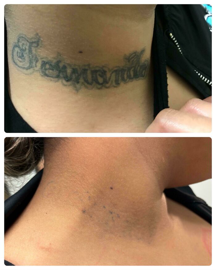 Faded tattoo on neck before and after removal showing how tattoo mistakes aren’t permanent anymore.
