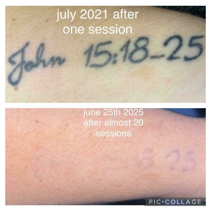 Faded tattoo after multiple sessions showing how tattoo mistakes can be removed over time.