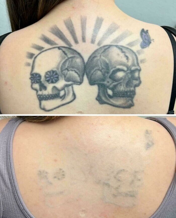 Before and after photos showing tattoo mistakes fading with advanced removal techniques on a person's upper back.