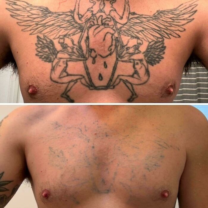 Before and after photos showing tattoo mistakes fading on a man's chest after laser removal treatment.