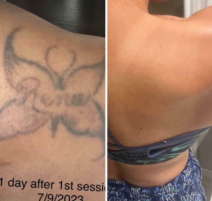 Faded butterfly tattoo on shoulder before and after removal showing tattoo mistakes fixed with no permanent marks.