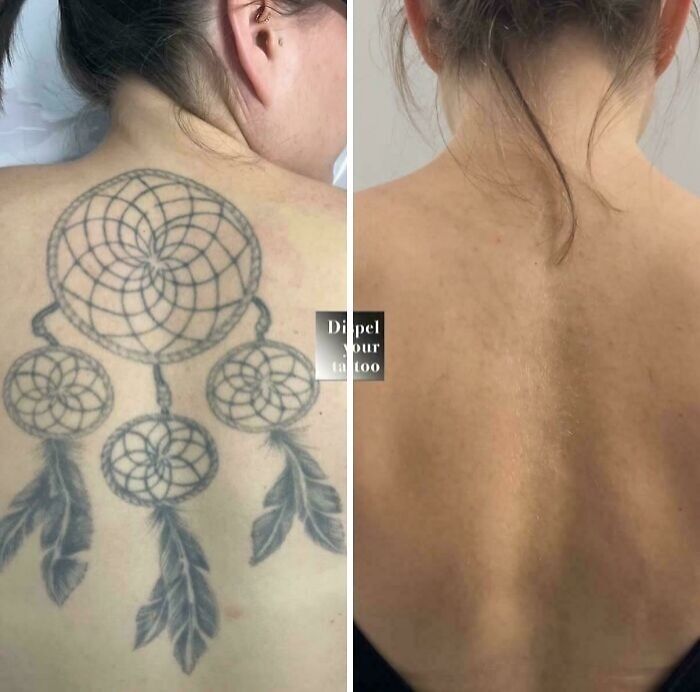 Before and after photos showing tattoo mistake removal on a woman's upper back with clear skin after treatment.