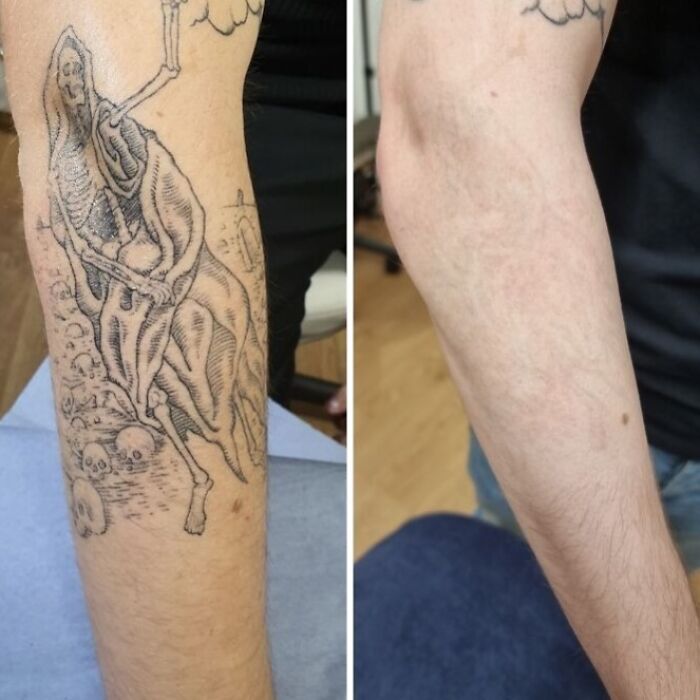Before and after tattoo removal photos showing the fading of a large black ink tattoo on a forearm.