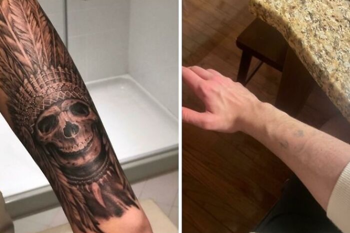 Before and after photos showing tattoo mistakes with a skull tattoo fully removed from a person's forearm.