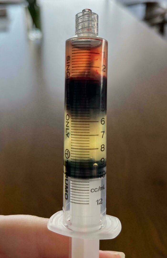 Syringe with separated dark blood and yellow plasma layers held between fingers, striking medical pics example