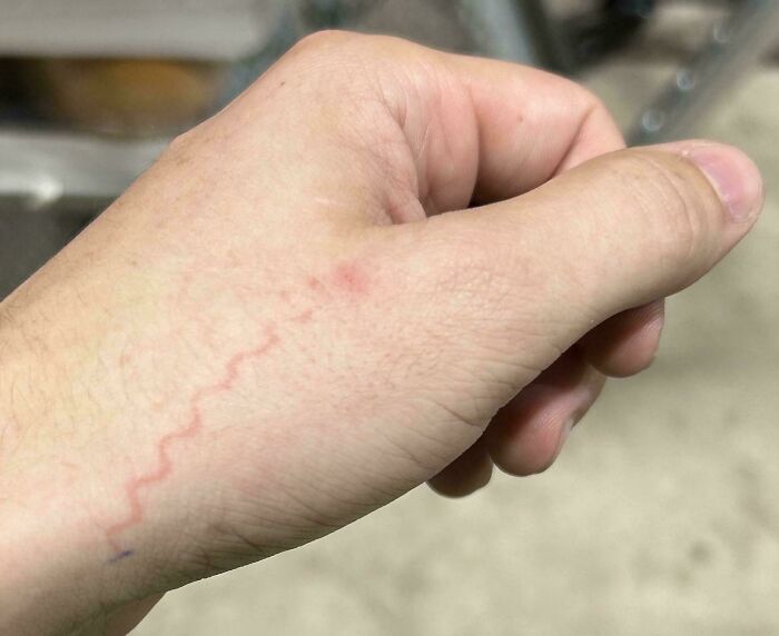 Close-up of a hand showing a moderately interesting red zigzag vein pattern, shared by people online.