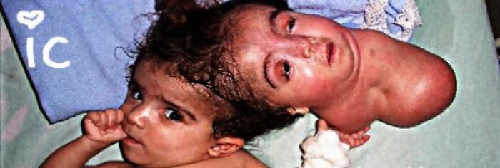Two young children lying close together, one with a rare medical condition affecting the head, a terrifying photo.