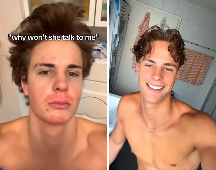 Before and after transformation showing clear skin and a confident smile after deciding to change.