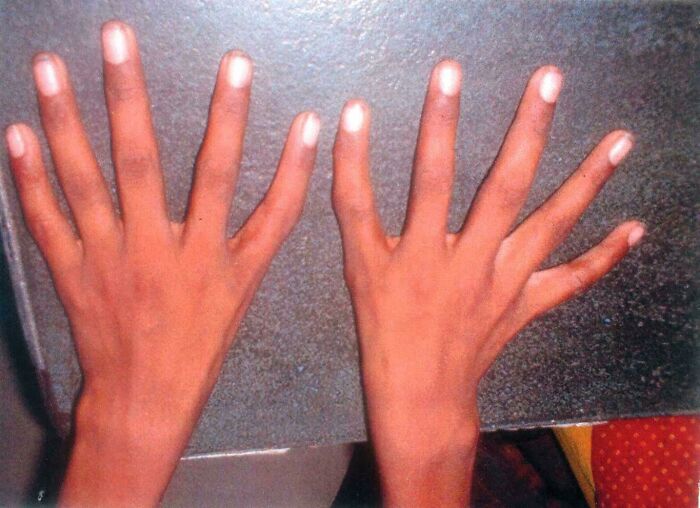 Hands with a rare finger formation showing surprising physical traits shared by people about their bodies.