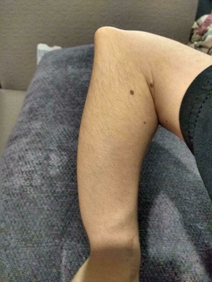Human arm bent unusually backward showing a rare and surprising physical trait on the body.