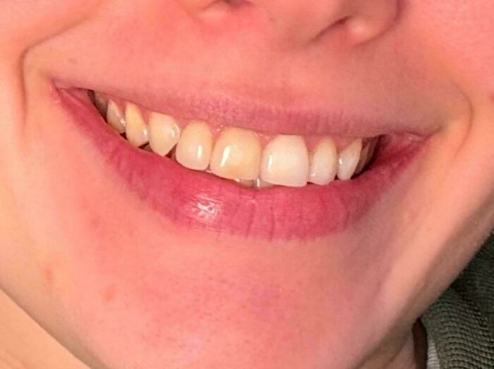 Close-up of a rare and surprising dental feature showing unique teeth alignment and color variations on smiling lips.