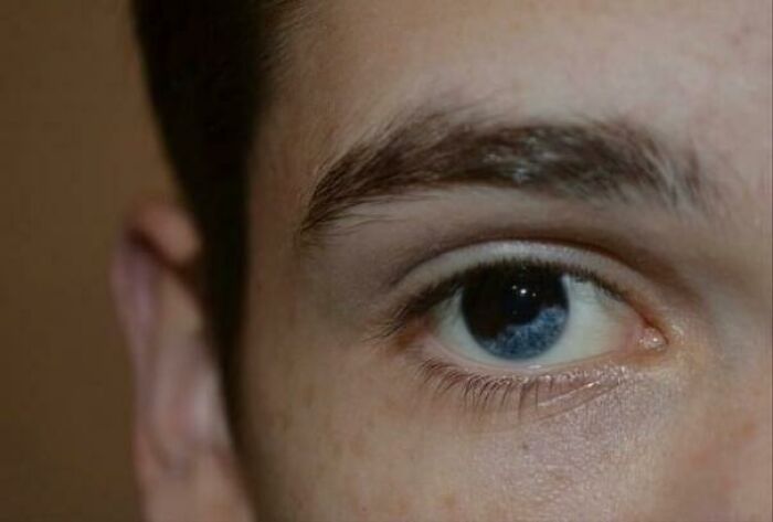 Close-up of a blue eye showing a rare and surprising feature of the human body in high detail.