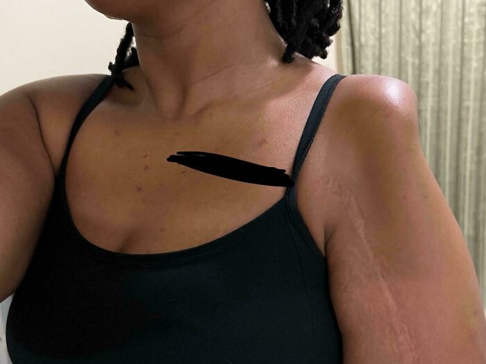 Close-up of a person showing rare and surprising skin features on their arm and shoulder.