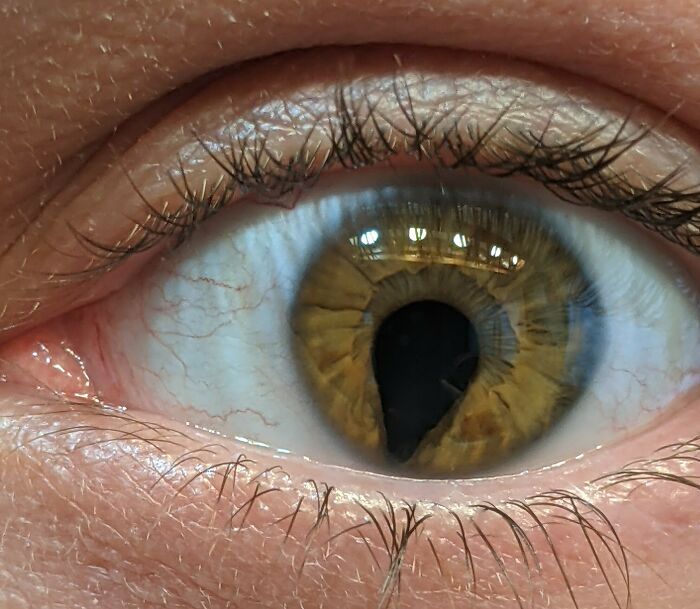 Close-up of a human eye showing a rare and surprising body feature with an irregularly shaped pupil.