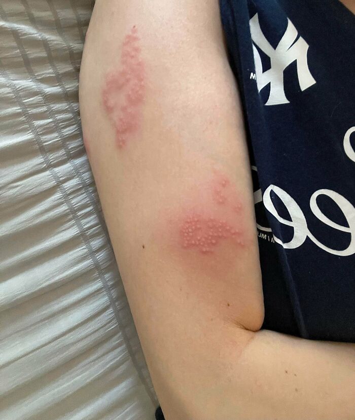 Red, blistered skin rashes on a person's arm showing worst luck on vacation injury or allergic reaction.