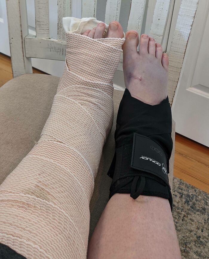 Two injured feet with one in a cast and the other in a brace, showing bad luck on vacation injuries.