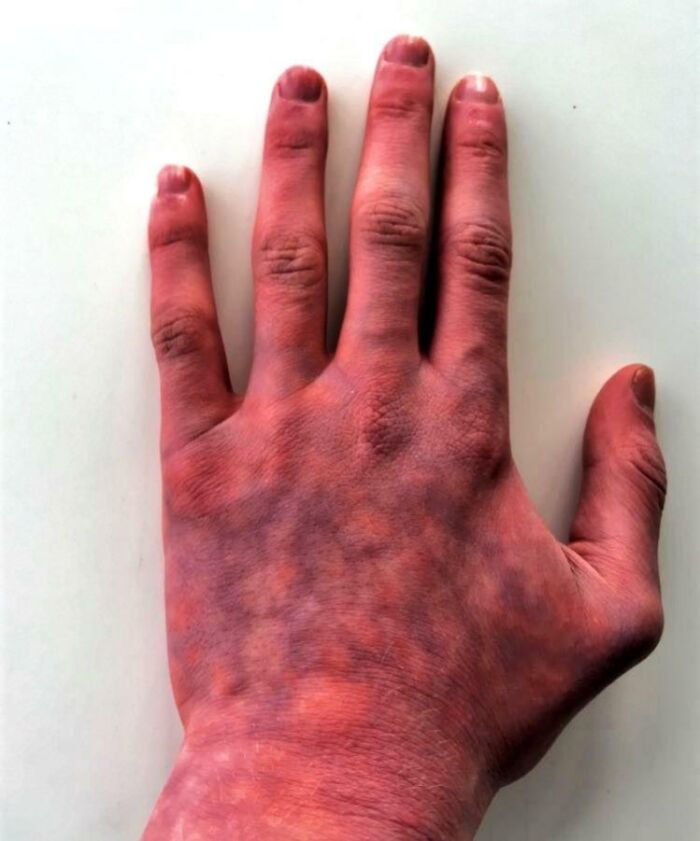 Close-up of a human hand showing rare and surprising skin discoloration as an unusual body feature.