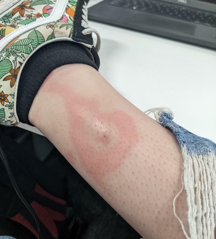 Close-up of a leg showing a rare circular red mark and visible hair follicles, highlighting surprising body features.