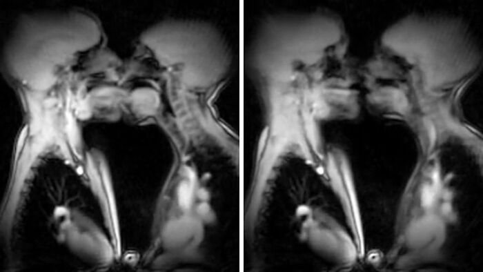 MRI scans showing rare and surprising body features of two people kissing, highlighting unique internal anatomy.