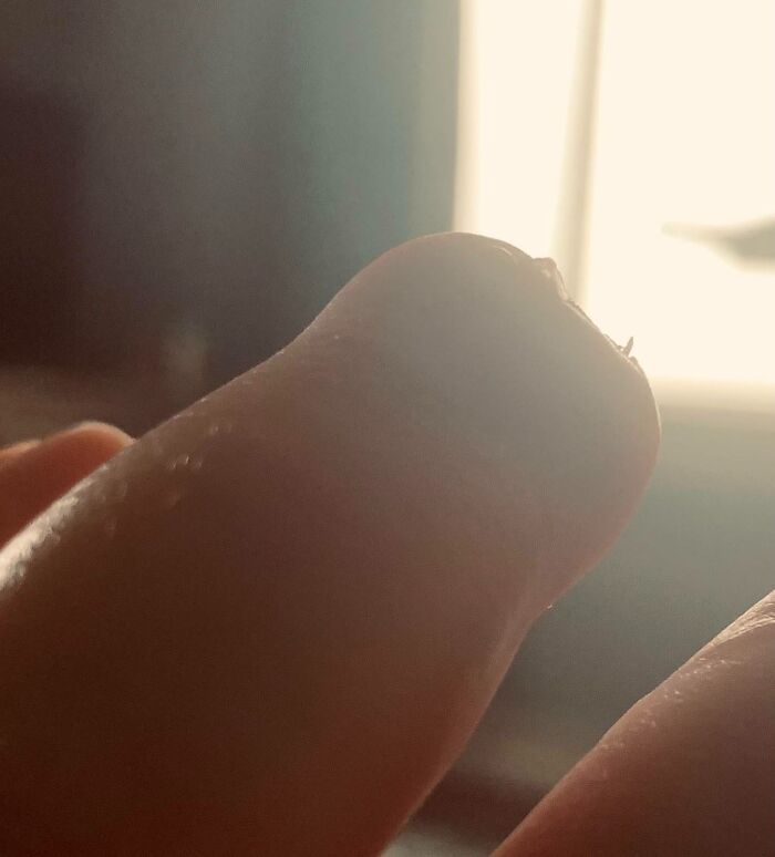 Close-up of a fingertip missing a nail, showing a rare and surprising body feature shared by people.