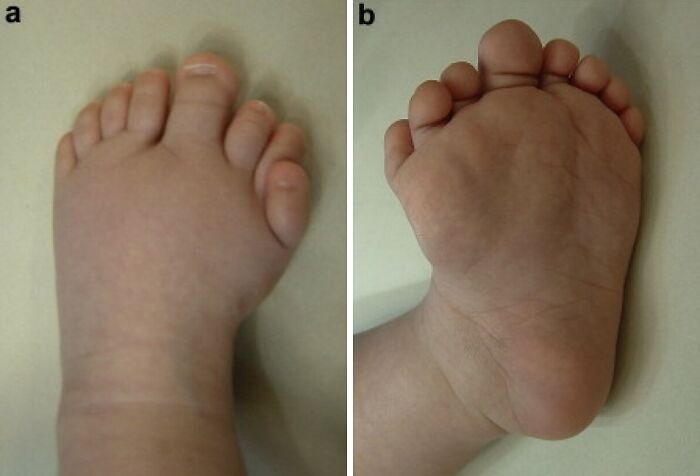 Close-up images of a rare foot condition showing unusual toe formation from different angles.