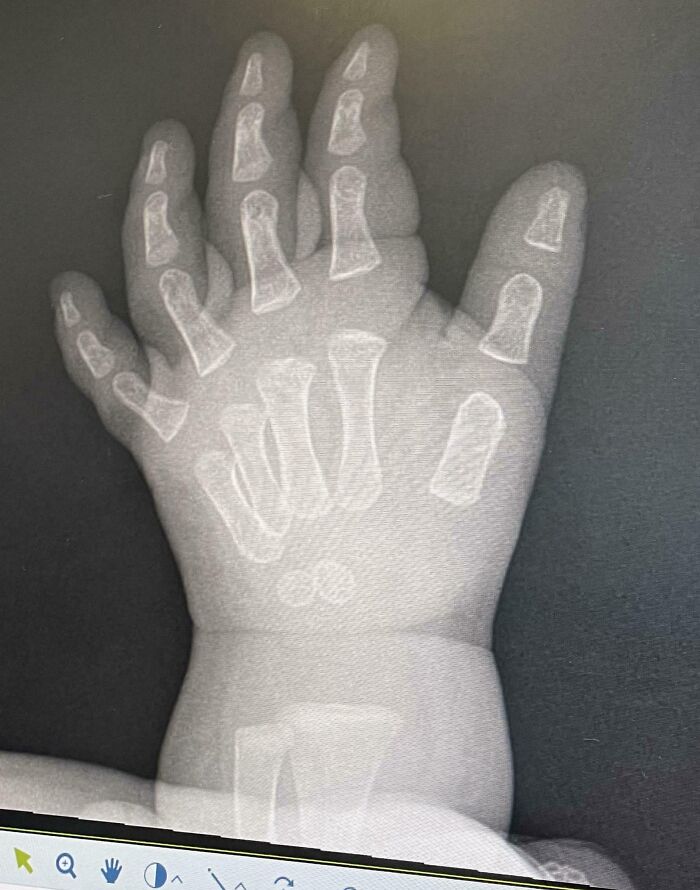 X-ray image showing a rare hand abnormality with extra fingers, highlighting surprising things about human bodies.