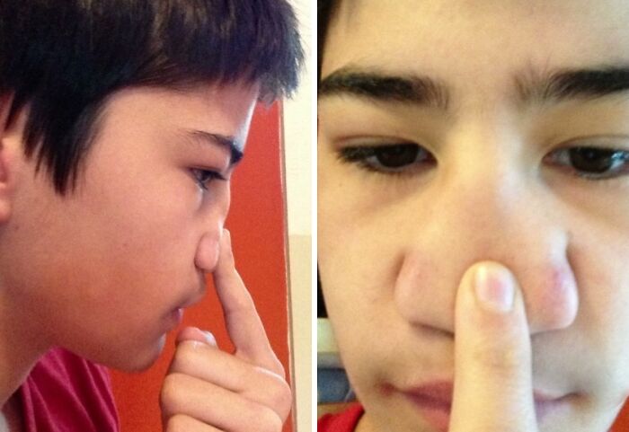 Close-up side and front views of a person showing a rare and surprising physical trait on their nose.