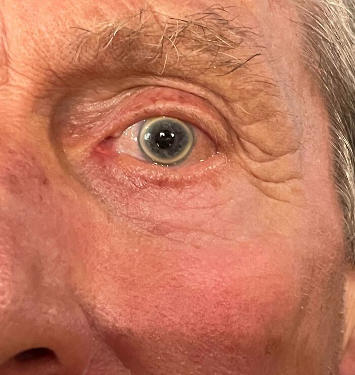 Close-up of an older person's eye showing rare and surprising physical features of their body.