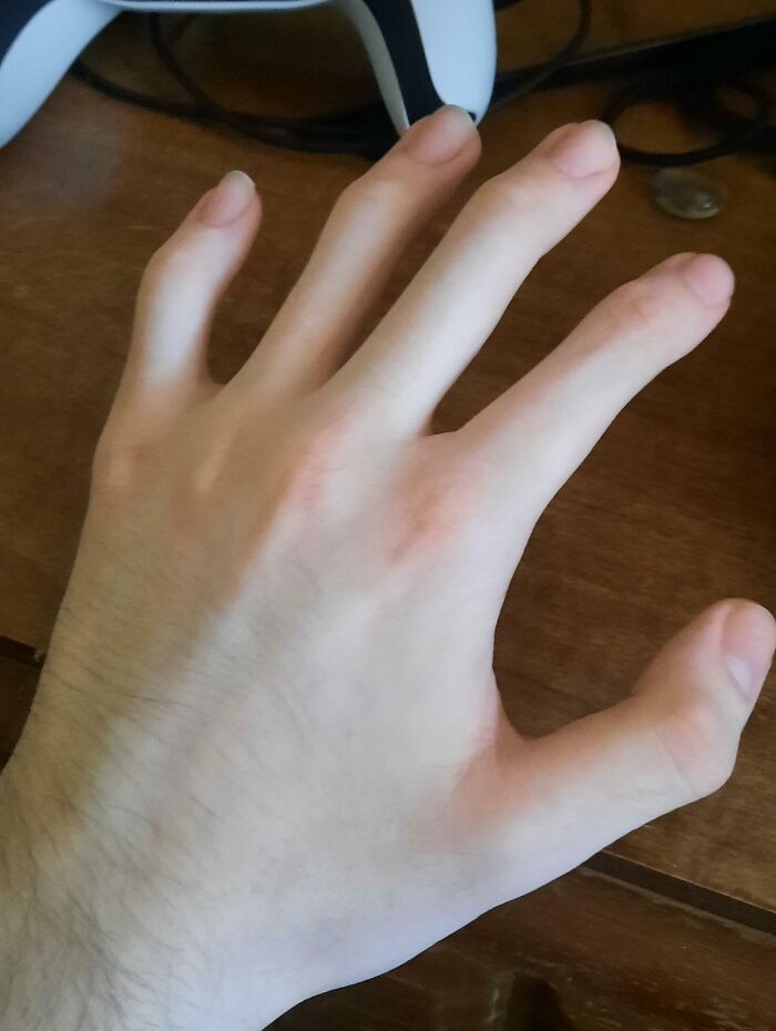 Close-up of a rare hand with an unusual finger shape, illustrating surprising things about their bodies.