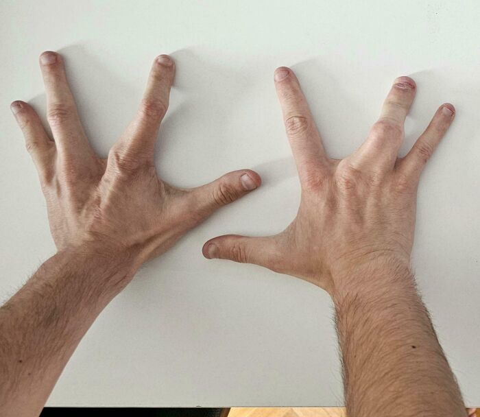 Two hands on a white surface showing a rare and surprising physical hand difference of fingers spread wide.