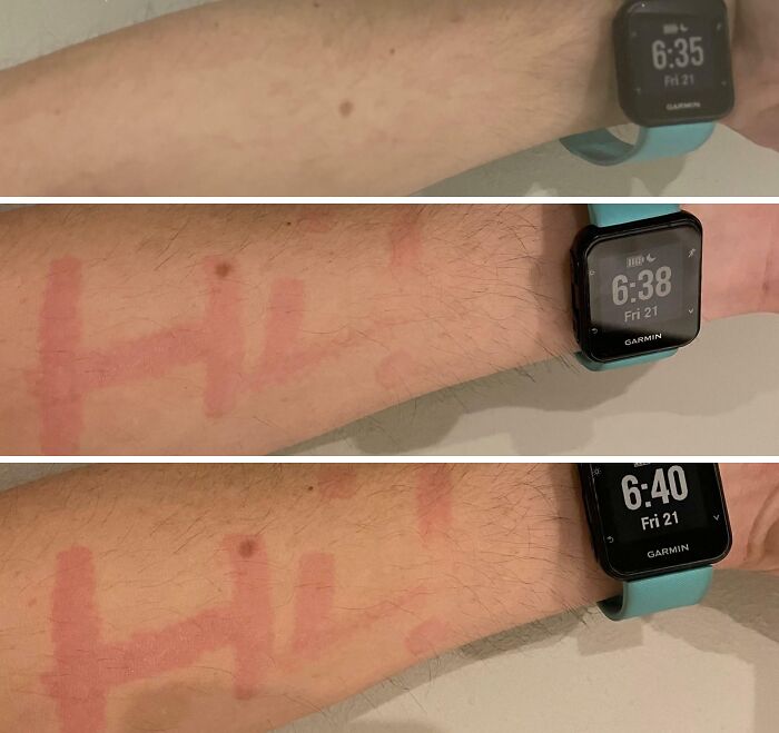 Arm showing rare skin redness pattern spelling Hi, highlighting surprising and rare things about human bodies.